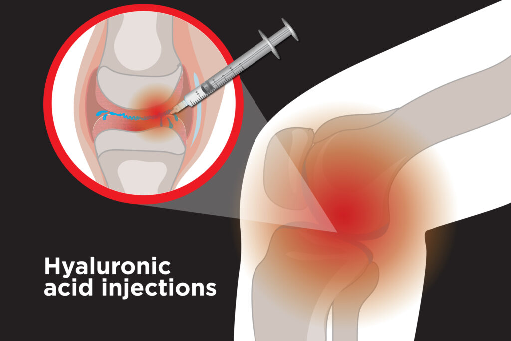 knee pain worse after gel injection
